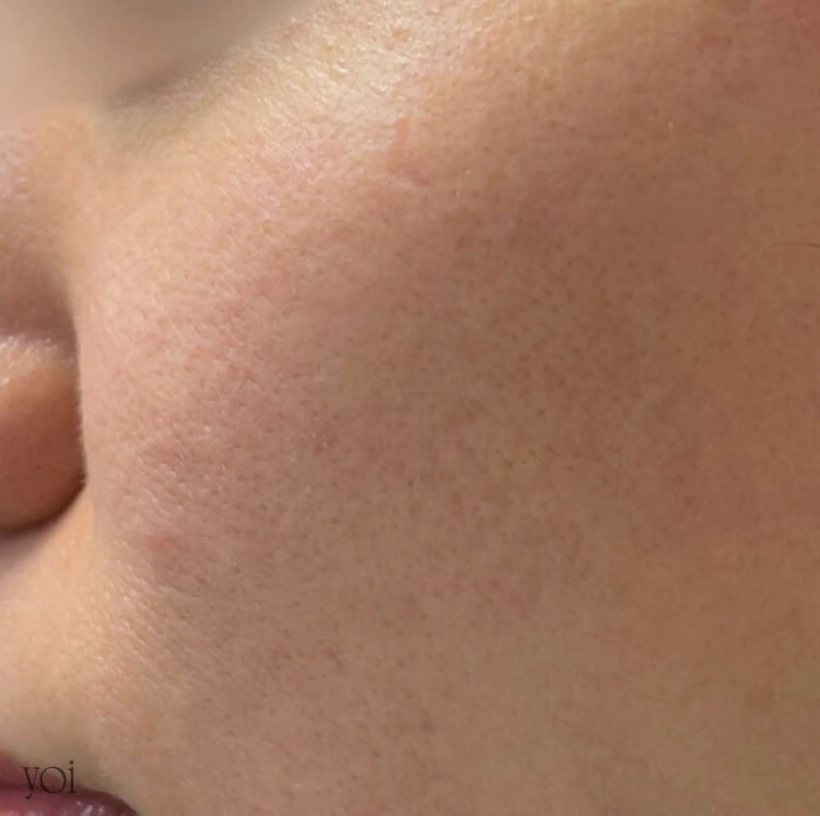 毛穴 美容医療 プルリアル アフター