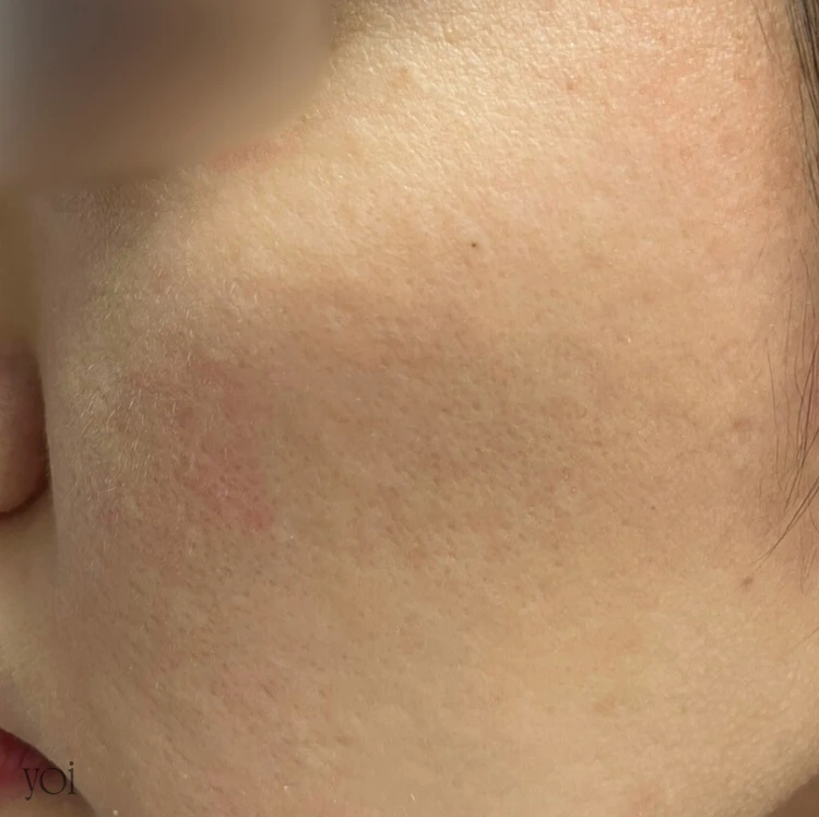 毛穴 美容医療 プルリアル ビフォー